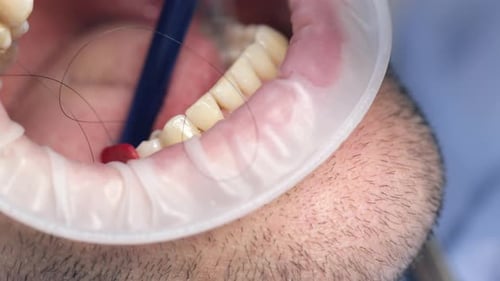 Dental Tooth Implantation Dental Gum Grafting As Preparation for Dental Implant Installation Dental