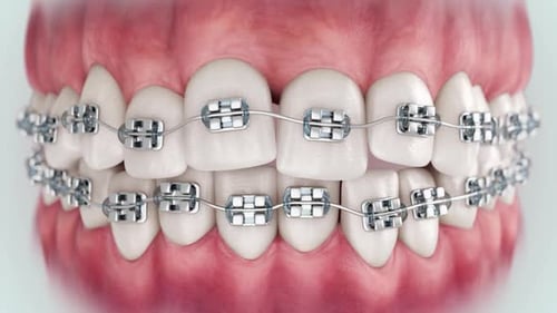 Brackets Up 16x9 004