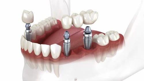 Dental bridge and crown placement over implants. Dental 3D animation concept