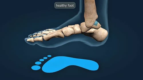 3D Animation Comparing Healthy Foot and Flat Foot Anatomy
