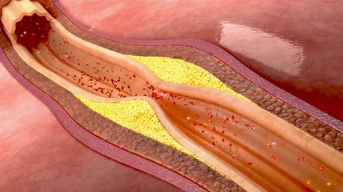 A close-up of a blood vessel with a blockage