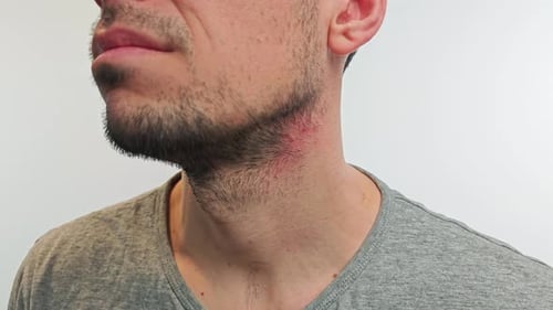 Hombre rascándose el cuello rojo e irritado con molestias visibles