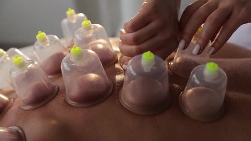 Closeup Cupping Therapy with Silicone Cups on Clients Back