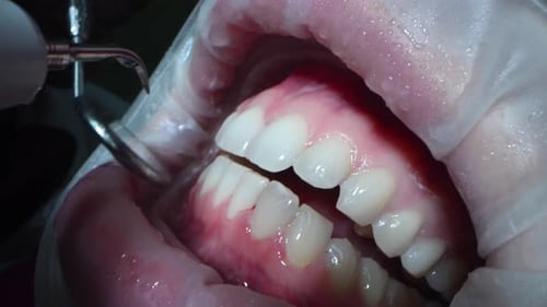 Dental Extreme Close Up Macro Video Dental Cleaning Process in Patient Mouth Clean Teeth and Gums