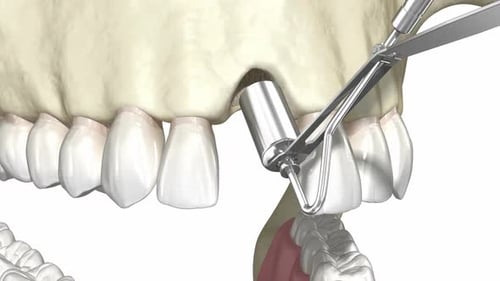 Injerto óseo: aumento con hueso y membrana artificiales, implantación dental