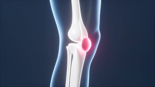 Human kneecap model, arthrophlogosis, joint swelling, joint pain, 3d rendering.