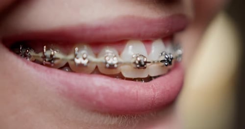Los soportes metálicos en los dientes y la importancia de mantener el cuidado bucal con aparatos ortopédicos