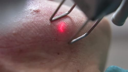 Laser Treatment on Skin in Hospital Close Up