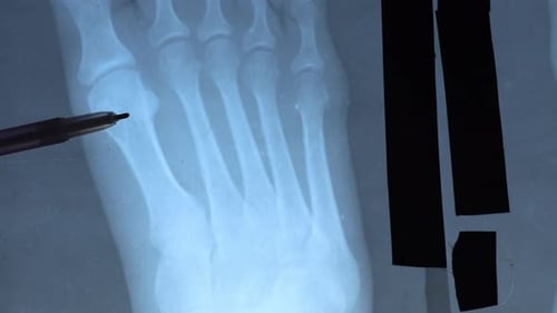 Foot X-Ray Examined with Pen