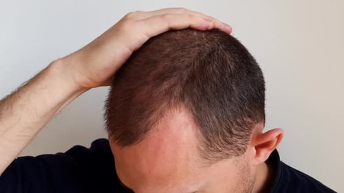 Young man starts balding. Hair loss. Run fingers over the head. Left profile.