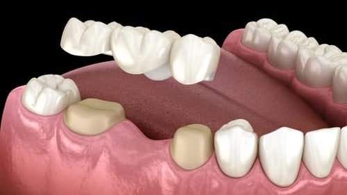3D Animation of Dental Bridge Installation on Lower Jaw