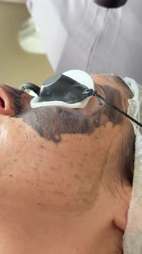 Young Woman Getting Carbon Laser Facial at Beauty Clinic Professional Skincare Treatment for Deep