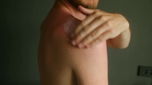 Mann trägt beruhigende Creme auf sonnenverbrannte Schulter auf
