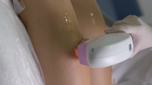 Laser Hair Removal Treatment on Woman's Leg
