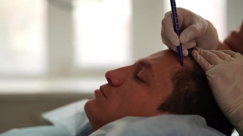 Trichologist Marking Hair Line to Male Patient with Hairloss Problem Point of Receding Hair Line for