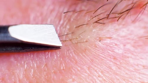 4K Super macro shot of hair removal with tweezers, on a caucasian person, at an extreme close up, in