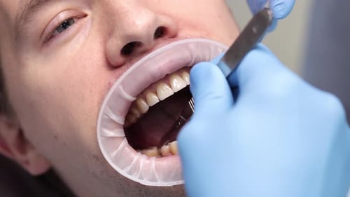Footage of Caucasian male patient getting dental treatment at modern dentist office.
