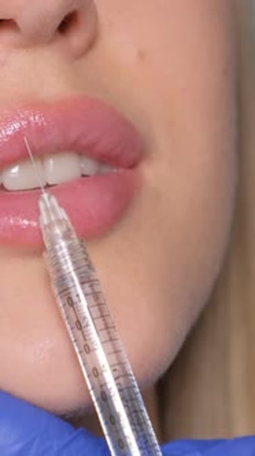 Cosmetic Lip Injections in Clinical Setting