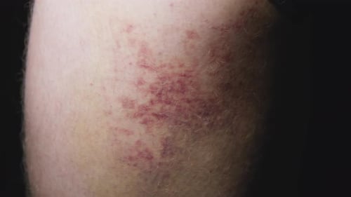 Large colourful bruise on leg. Painful wound recovery. 4k