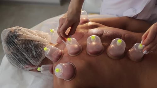 Cupping Therapy Treatment on Woman's Back in Clinic