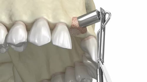 3D Animation of Dental Implant Placement Procedure