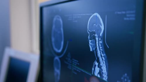 tomografía computarizada del cerebro con imagen de representación 3D del tumor en la pantalla en una clínica de investigación del cuerpo humano