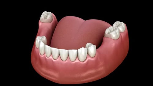 3D Animation of Removable Partial Dental Prosthesis Insertion