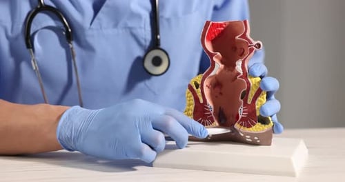 Doctor showing model of unhealthy lower rectum with inflamed vascular structures at wooden table