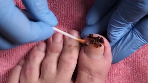 30m. A medicinal ointment is applied to the nail affected by the fungus. Treatment of nail fungus wi