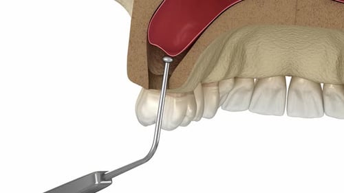 Sinus Lift Surgery with frontal access. 3D animation of dental surgery