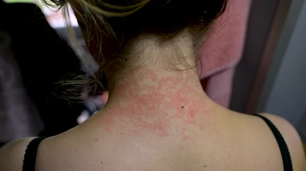Closeup of a Young Woman's Face Showing Redness and Irritation Visible ...