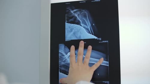 Hand Points to Shoulder X-Ray Images