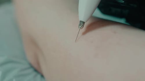 Cosmetic Procedure on Arm with Close Up View