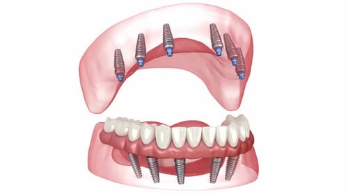 Prostheses supported by 6 implants. Dental 3D animation