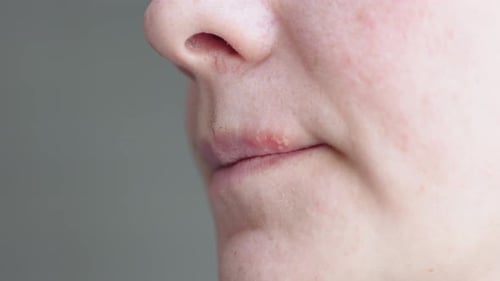 Herpès sur les lèvres, vésicules, petites bosses, boutons, cloques sur la lèvre supérieure, femme