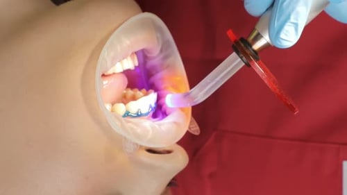 Gros plan de la procédure de blanchiment des dents avec une lampe à ultraviolets (vidéo verticale)