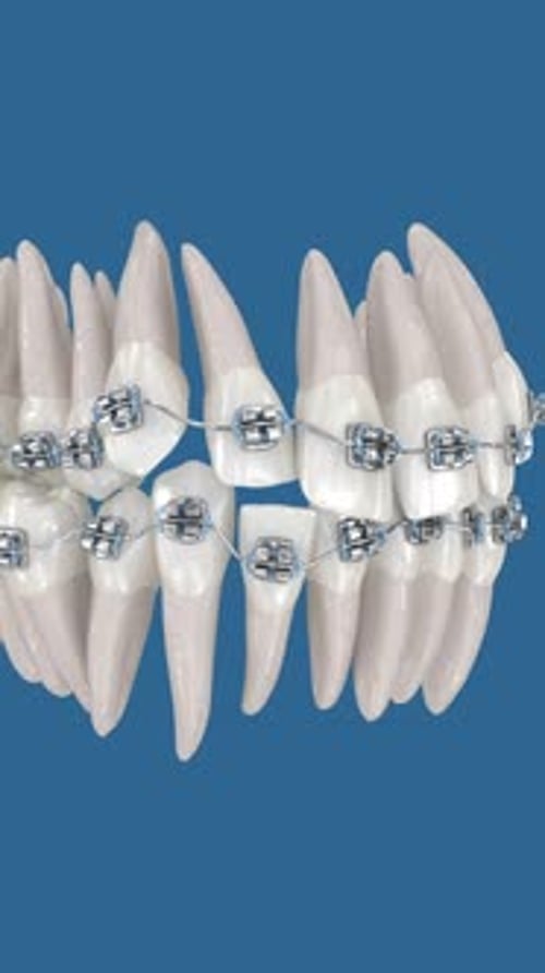 Animated Braces Correcting Teeth Alignment for Orthodontic Treatment