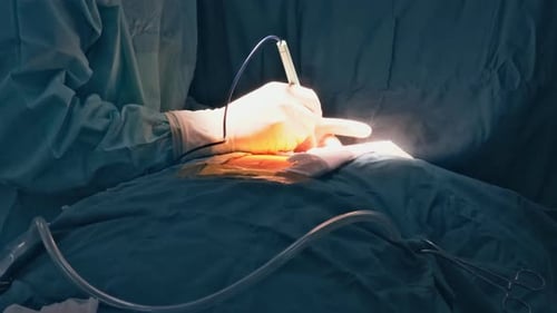 Order to Perform Open Heart Surgery a Chest Dissection is Required