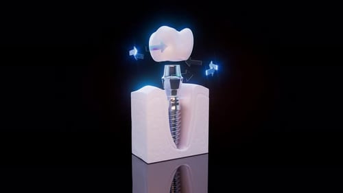 3D Dental Implant Placement with Bone Integration Animation