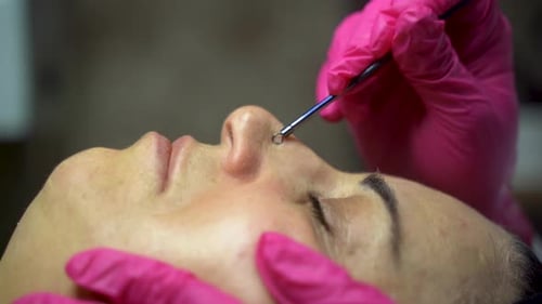 Woman Receives Blackhead Extraction Facial Treatment