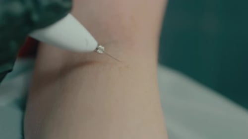Plasma Treatment on Arm in Medical Setting