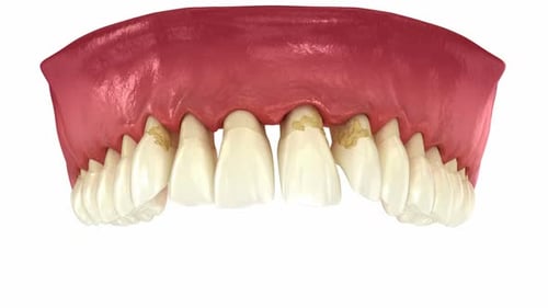 Periodontitis and gum recession in dynamics, teeth losing