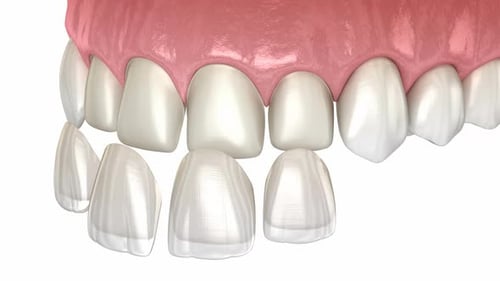 Dental Veneers placement over teeth
