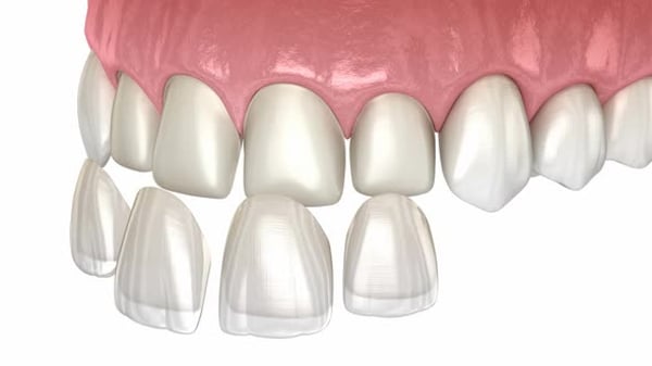 Veneer installation procedure over central incisor. , Backgrounds ...