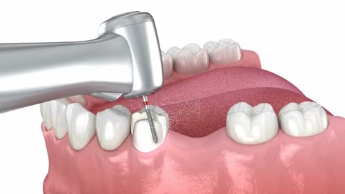 Dental bridge placement. Medically accurate 3D animation