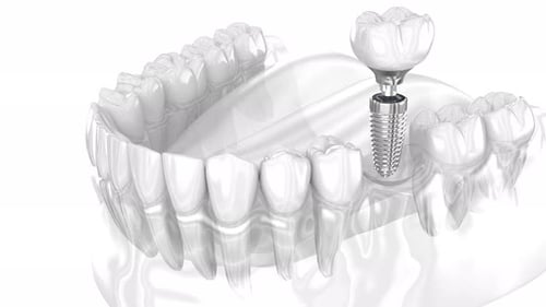3D Animation of Dental Implant Placement Procedure