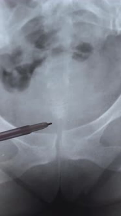 Medical X-Ray with Pen Pointing to Bones