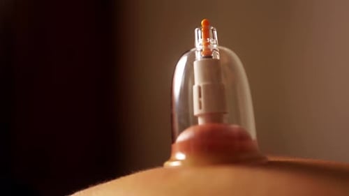 Cup therapy at spa. Chinese vacuum suction treatment for pain relief