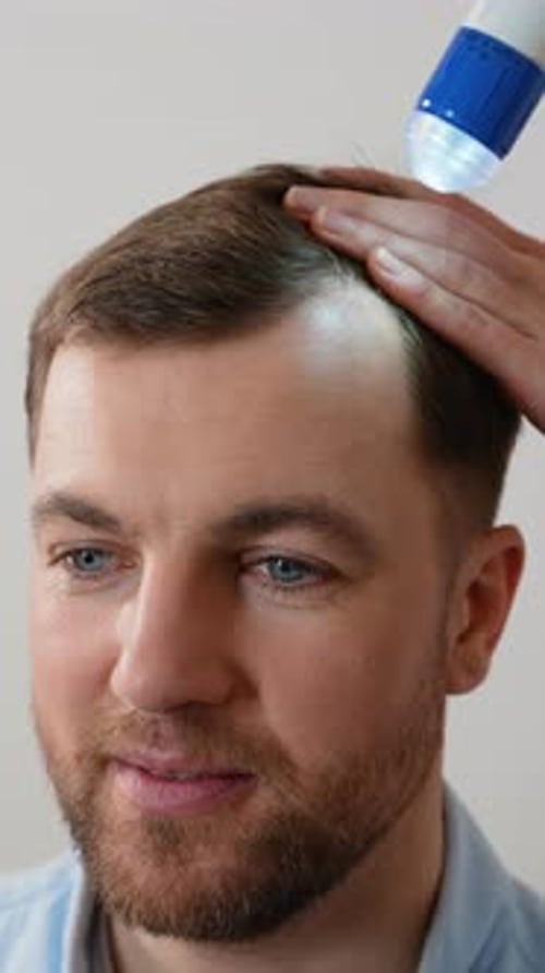 Man with Dandruff Undergoing Scalp Examination at Trichologist