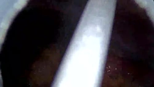 Appendicitis Surgery. View from the surgical camera of the process of removing Appendix_part02